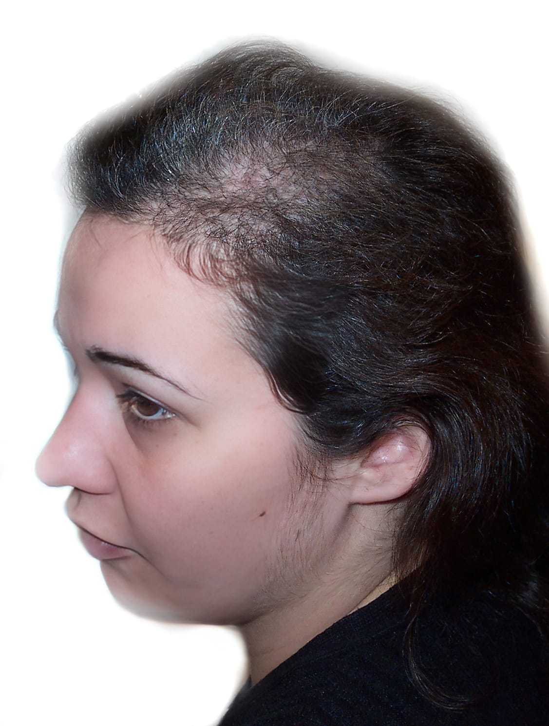 Before Picture - Trichotillomania Success - Now Pull-Free